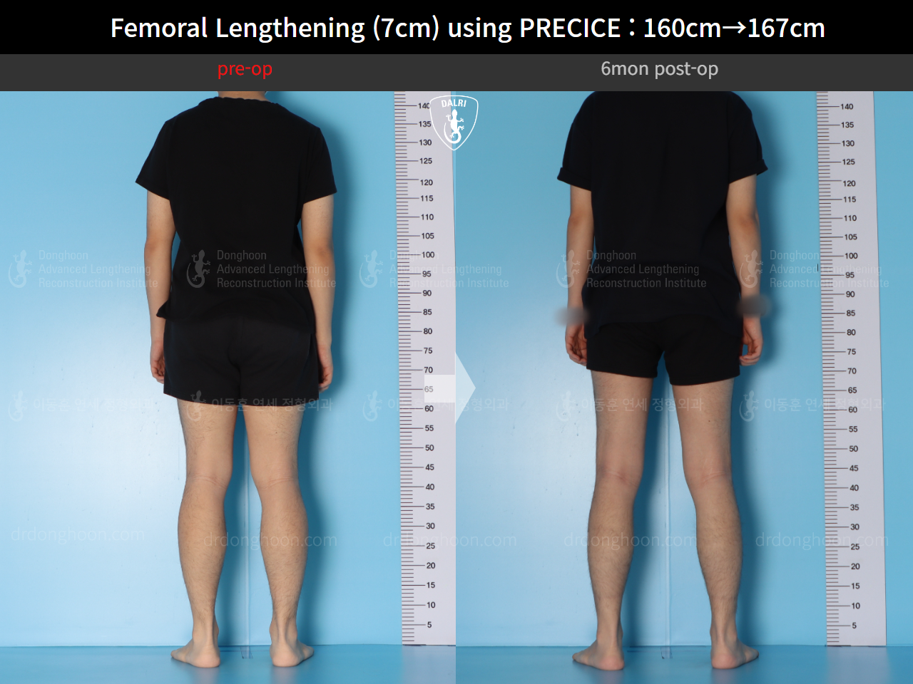 Before and after cll precice, case 15460533, image 4, Dr. Donghoon institute (DALRI)