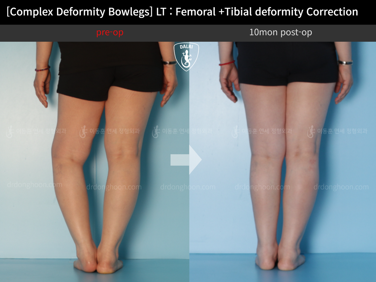 Before and after adult bowlegs, case 12790433, image 5, Dr. Donghoon institute (DALRI)