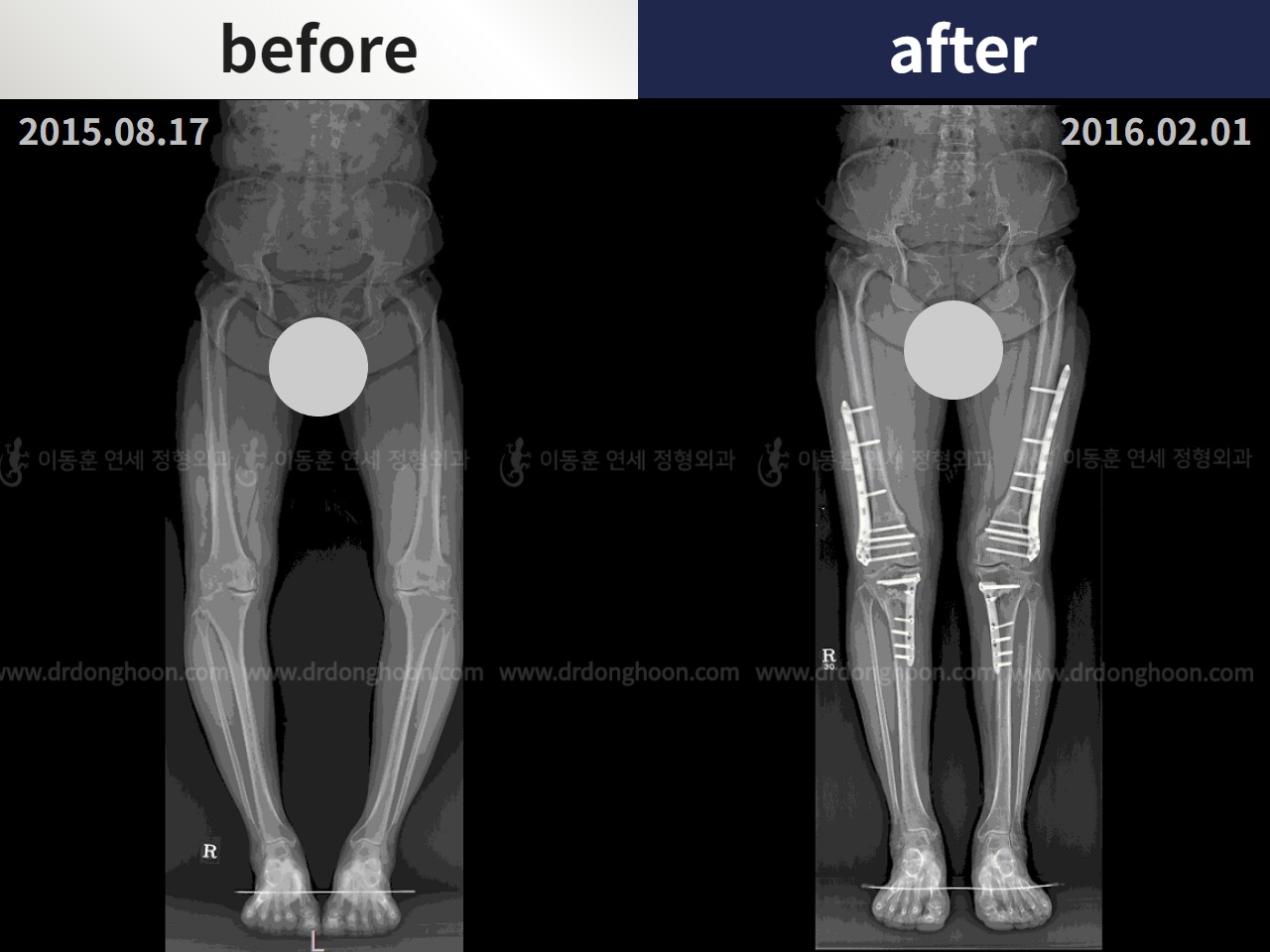 Before and after osteotomy for knee osteoarthritis, case 4872701, image 3, Dr. Donghoon institute (DALRI)