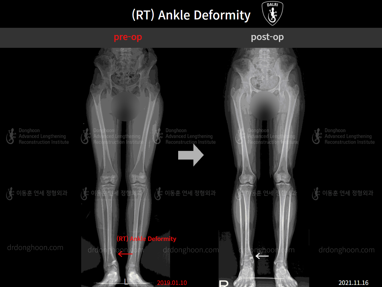 Before and after foot & ankle deformity, case 4248008, image 5, Dr. Donghoon institute (DALRI)