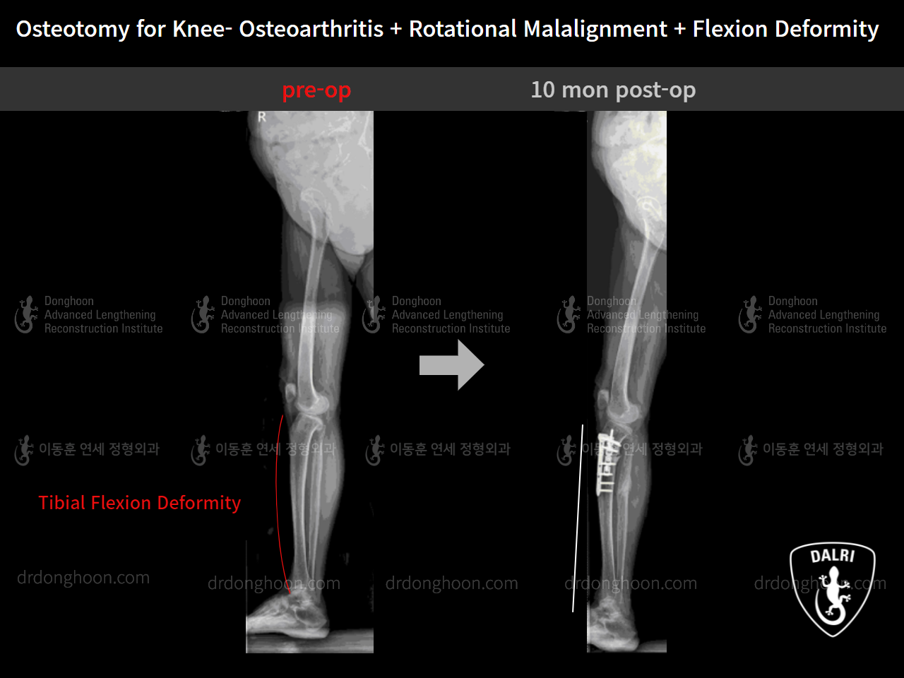 Before and after osteotomy for knee osteoarthritis, case 9128503, image 9, Dr. Donghoon institute (DALRI)