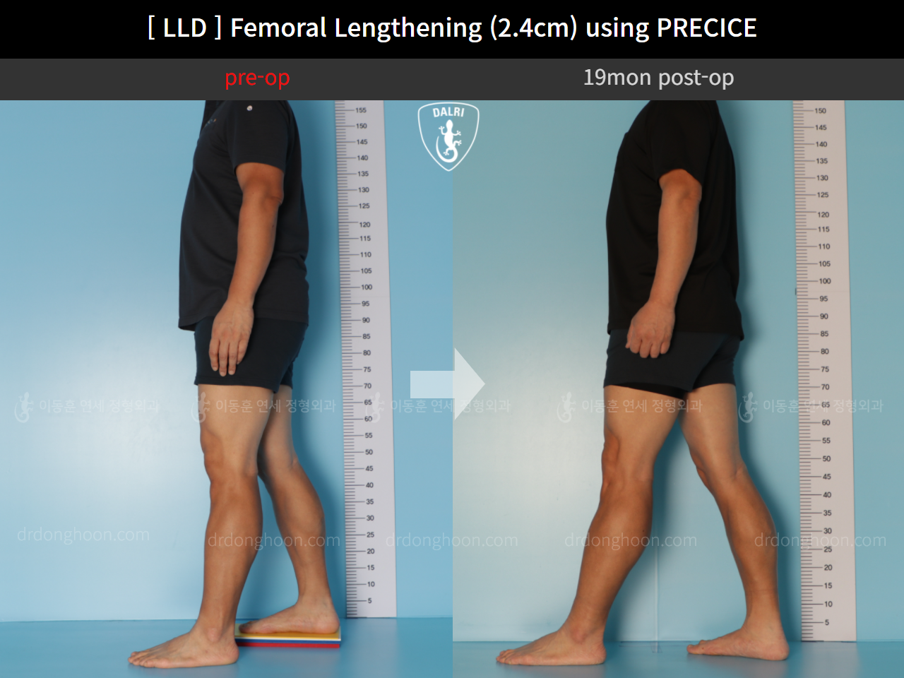 Before and after adult lld, case 10990486, image 4, Dr. Donghoon institute (DALRI)