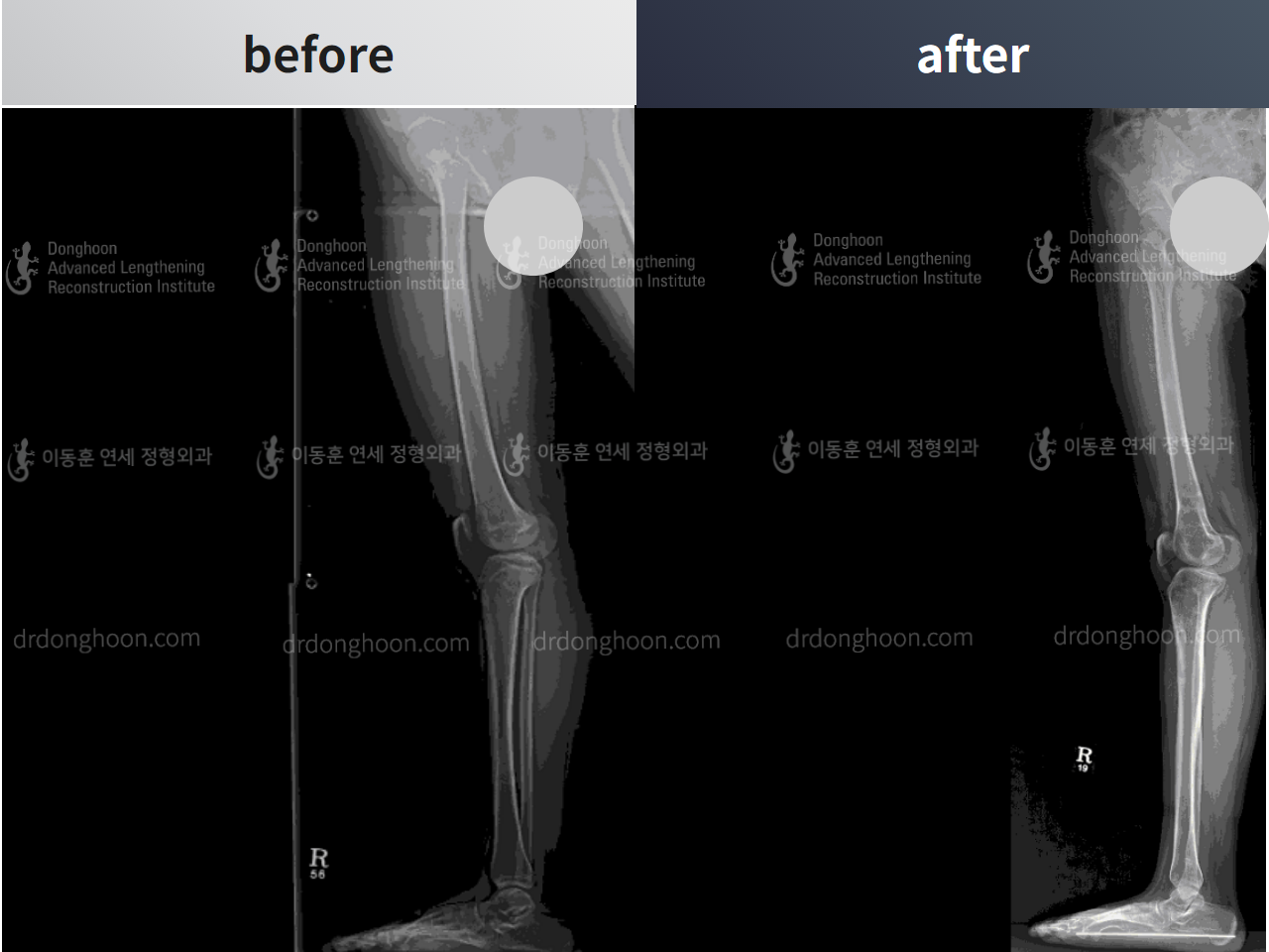 Before and after paediatric & adolescent bowlegs, case 4320276, image 5, Dr. Donghoon institute (DALRI)