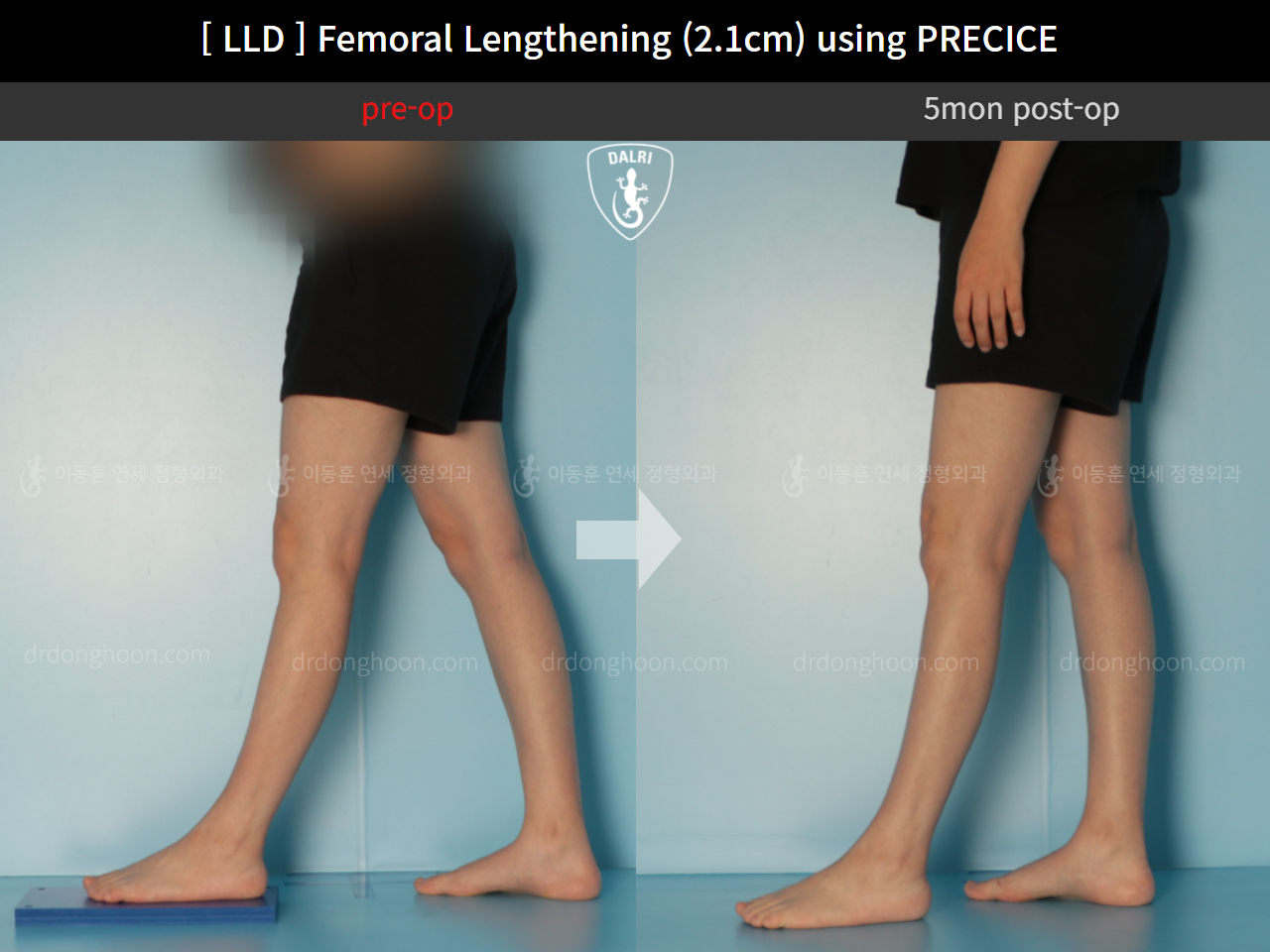Before and after adult lld, case 11784618, image 6, Dr. Donghoon institute (DALRI)