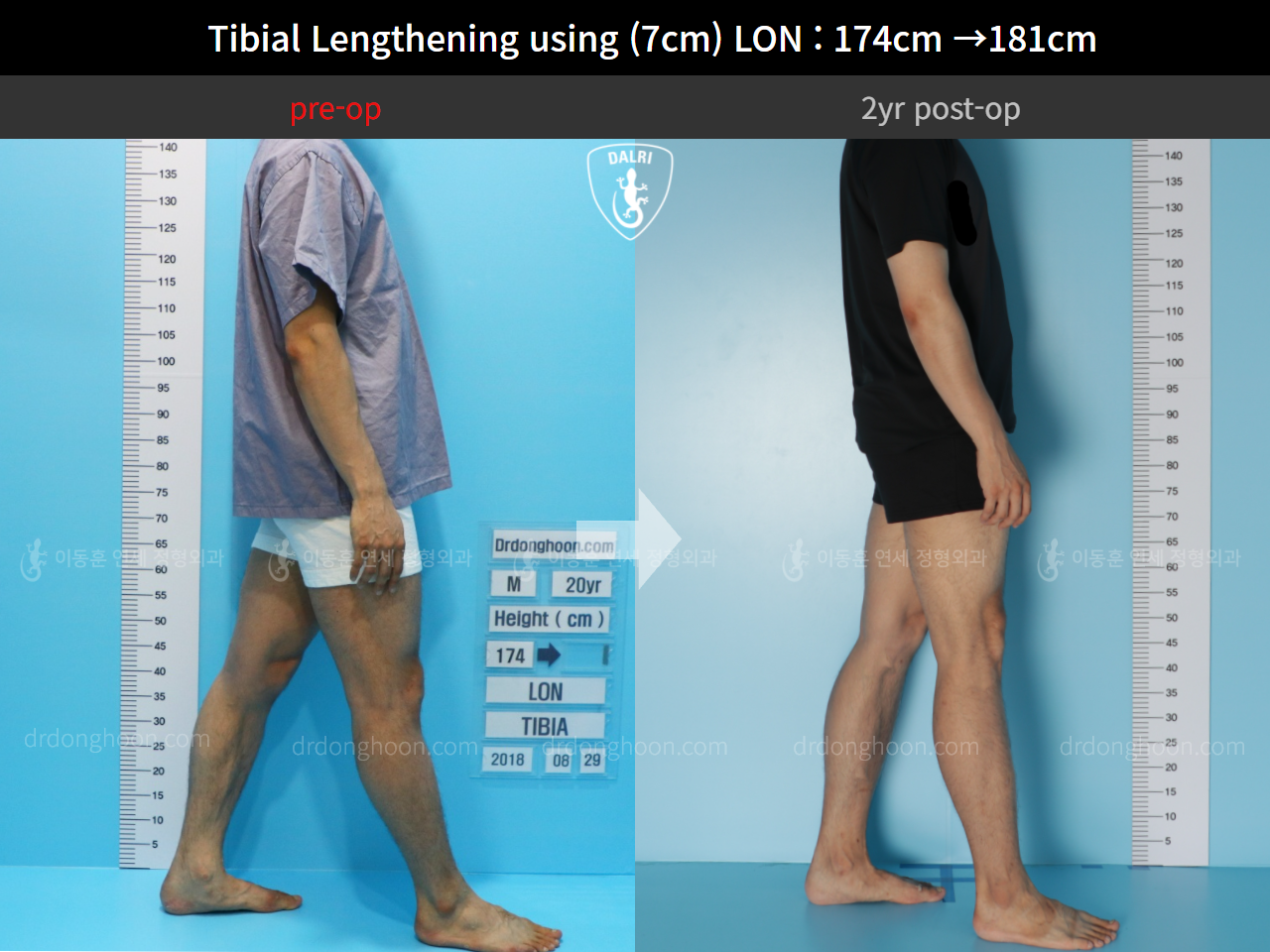 Before and after cll lon, case 5316185, image 4, Dr. Donghoon institute (DALRI)