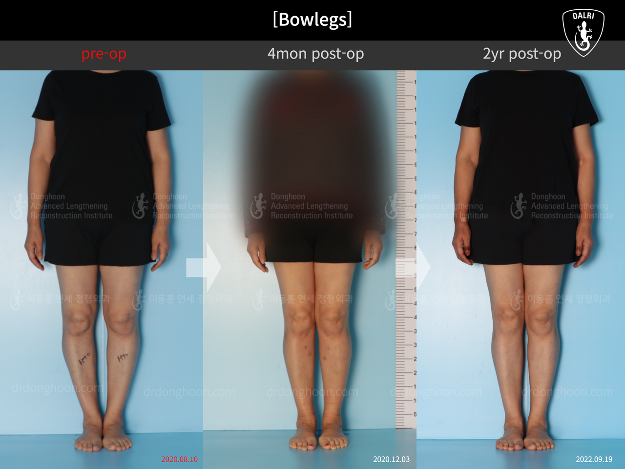 Before and after adult bowlegs, case 13250883, image 1, Dr. Donghoon institute (DALRI)