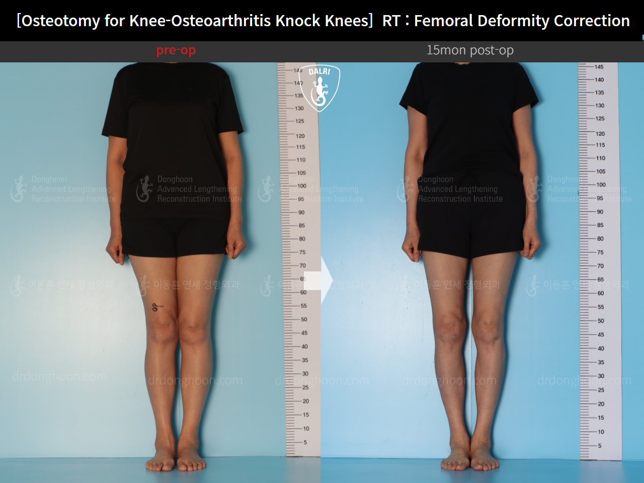 Before and after osteotomy for knee osteoarthritis, case 14462707, image 3, Dr. Donghoon institute (DALRI)