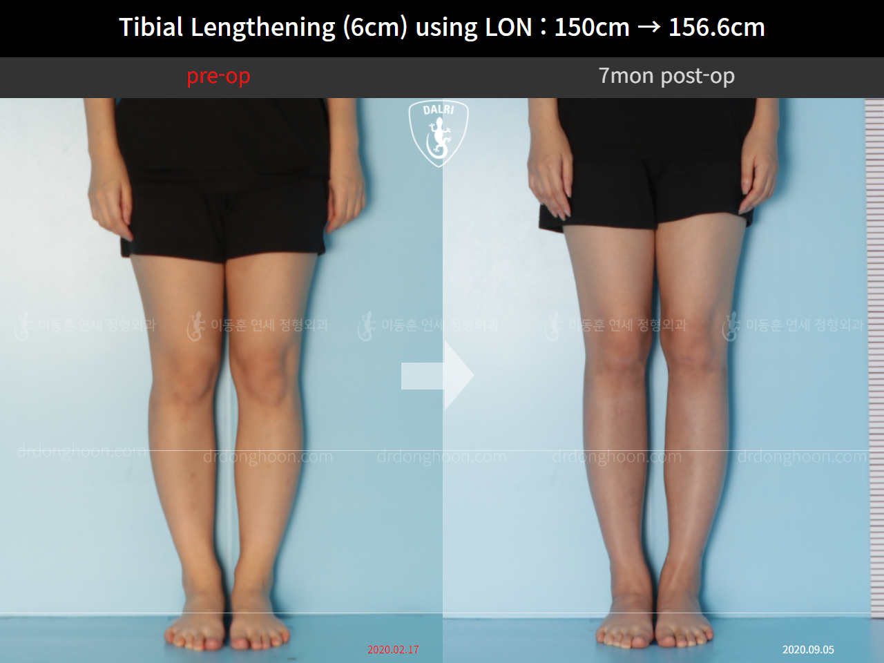 Before and after cll lon, case 9992030, image 5, Dr. Donghoon institute (DALRI)
