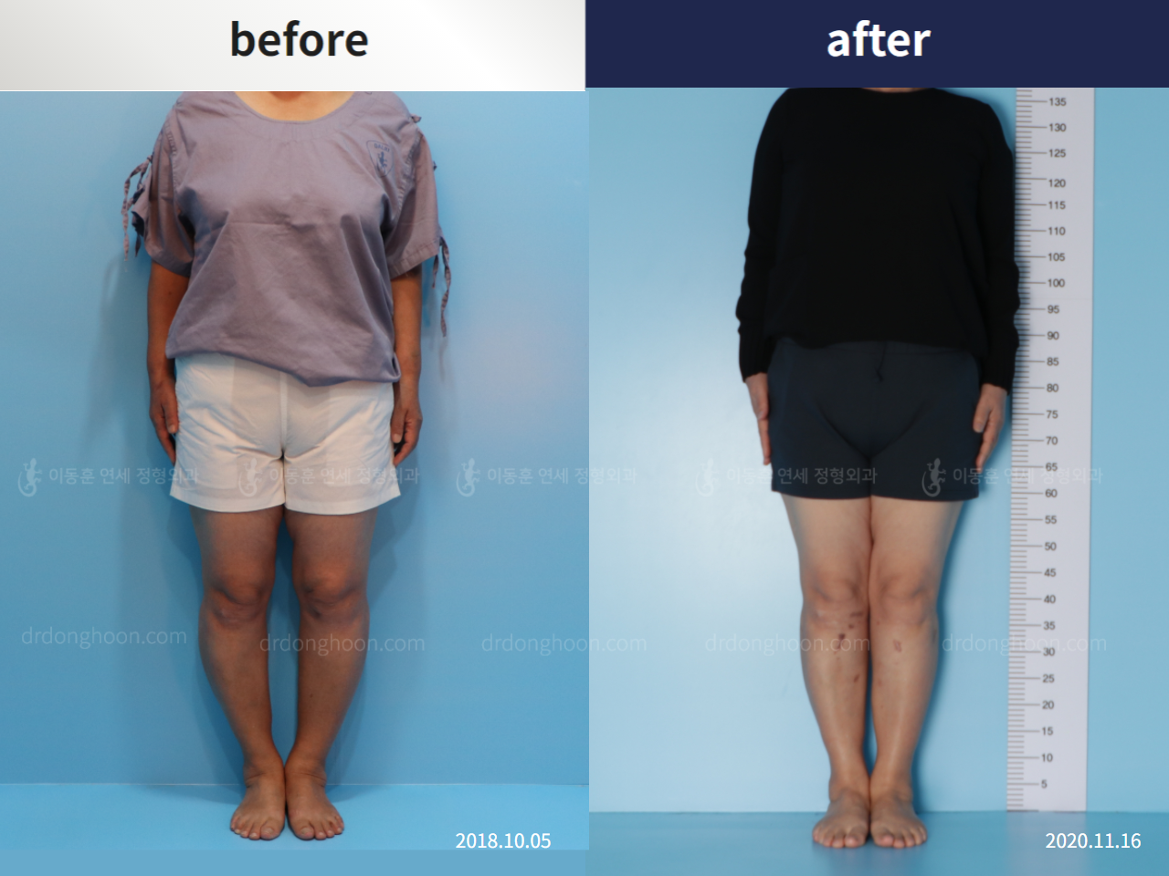 Before and after osteotomy for knee osteoarthritis, case 5346296, image 2, Dr. Donghoon institute (DALRI)
