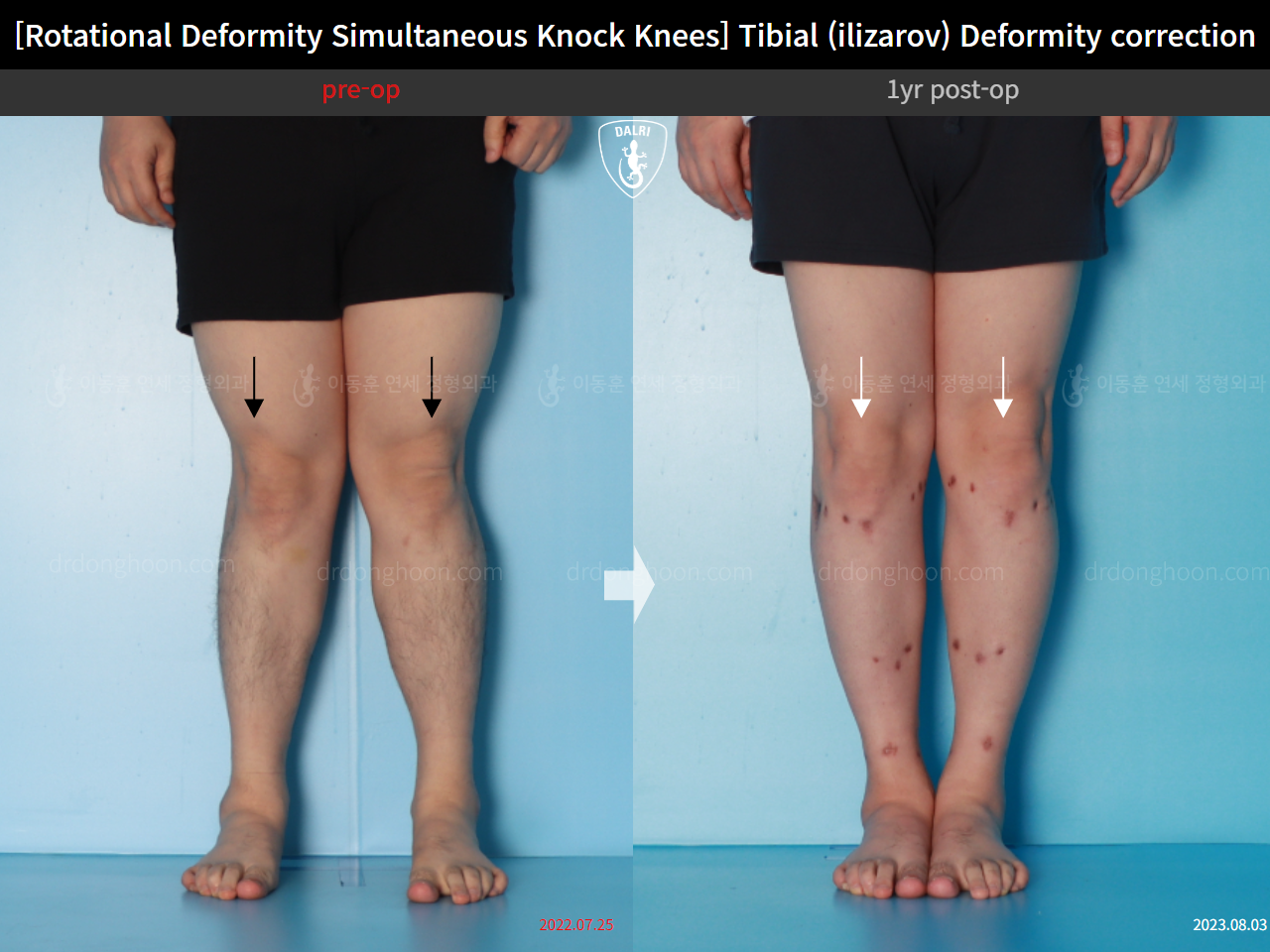 Before and after adult knock knees, case 15977455, image 5, Dr. Donghoon institute (DALRI)