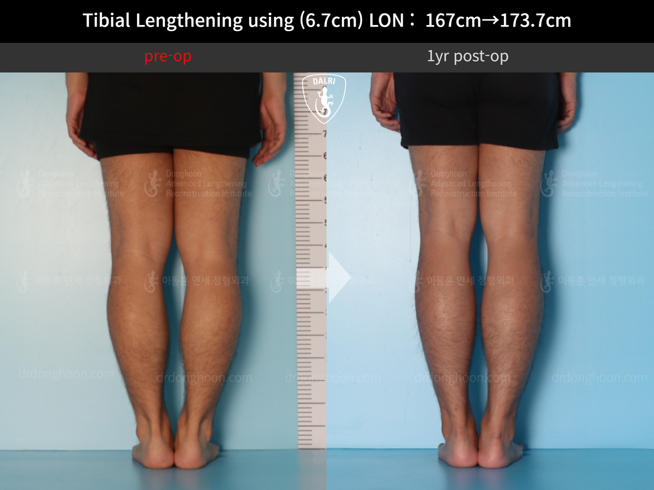 Before and after cll lon, case 12426969, image 6, Dr. Donghoon institute (DALRI)