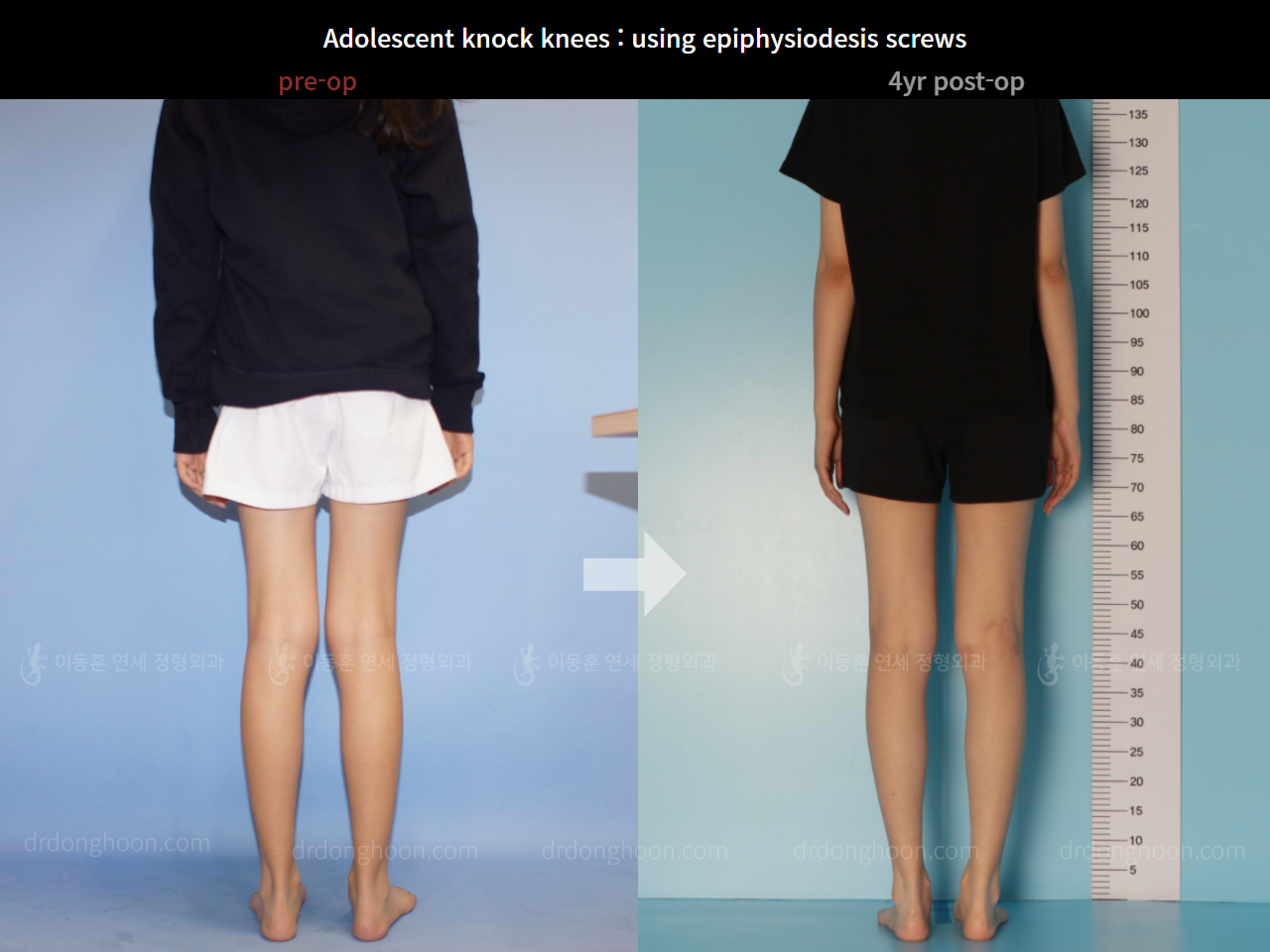 Before and after paediatric & adolescent knock knees, case 7695201, image 2, Dr. Donghoon institute (DALRI)