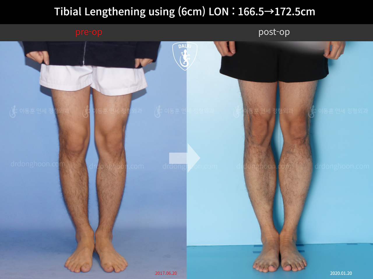 Before and after cll lon, case 11980239, image 5, Dr. Donghoon institute (DALRI)