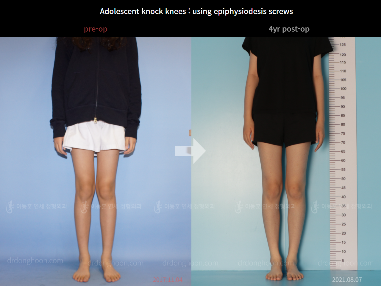 Before and after paediatric & adolescent knock knees, case 7695201, image 1, Dr. Donghoon institute (DALRI)