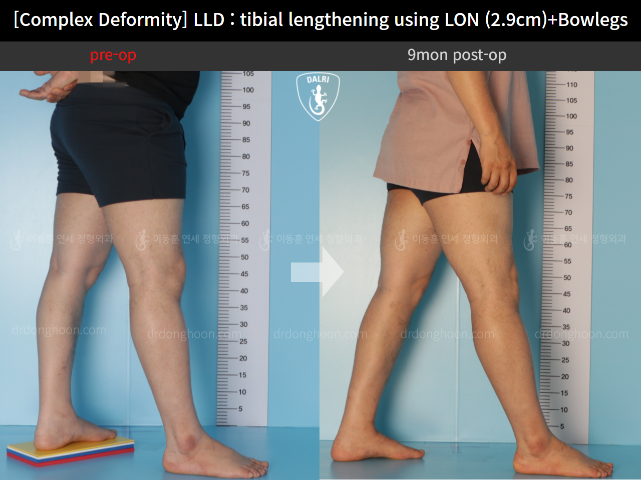 Before and after complex deformity, case 11233983, image 6, Dr. Donghoon institute (DALRI)