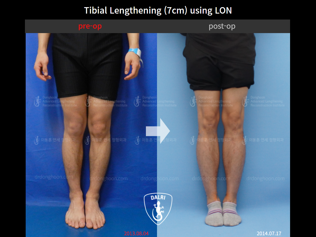 Before and after cll lon, case 4323927, image 3, Dr. Donghoon institute (DALRI)