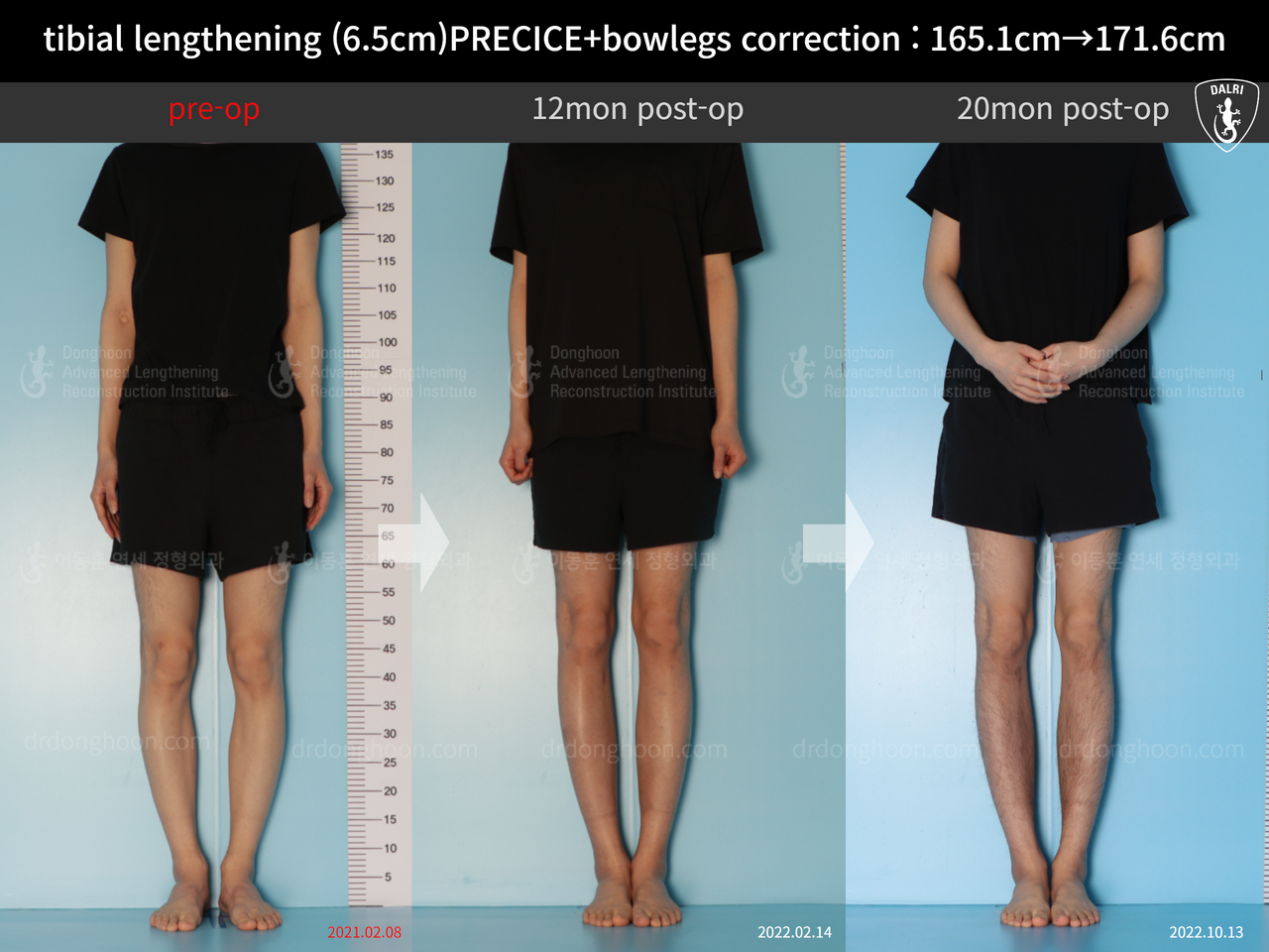 Before and after cll + deformity correction, case 13168253, image 1, Dr. Donghoon institute (DALRI)