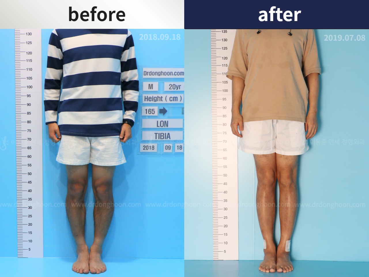 Before and after cll + deformity correction, case 4585674, image 1, Dr. Donghoon institute (DALRI)