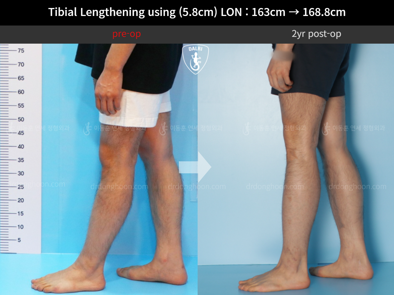 Before and after cll lon, case 11468172, image 7, Dr. Donghoon institute (DALRI)