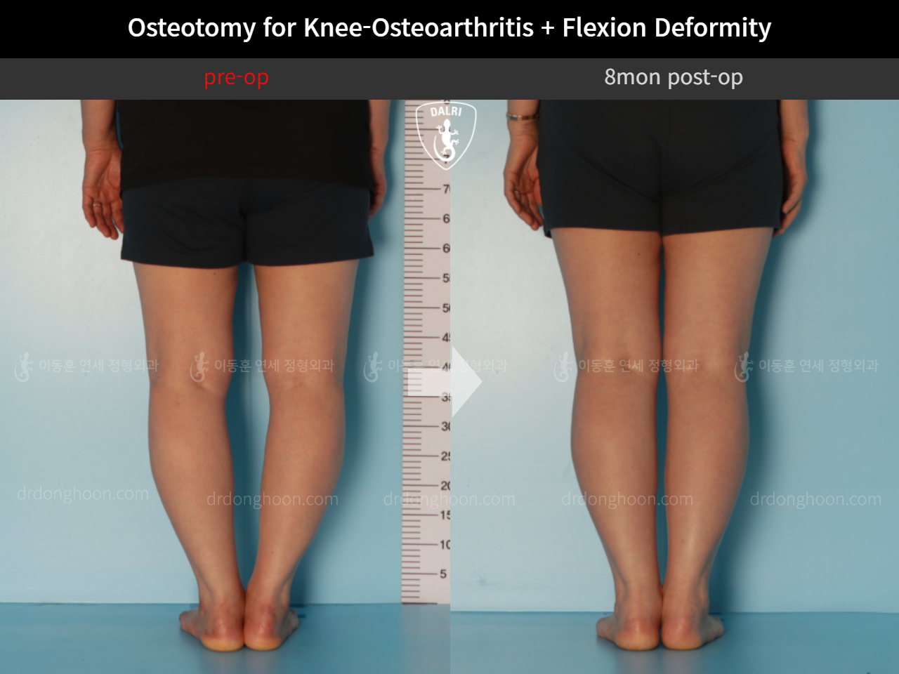 Before and after osteotomy for knee osteoarthritis, case 10663581, image 6, Dr. Donghoon institute (DALRI)