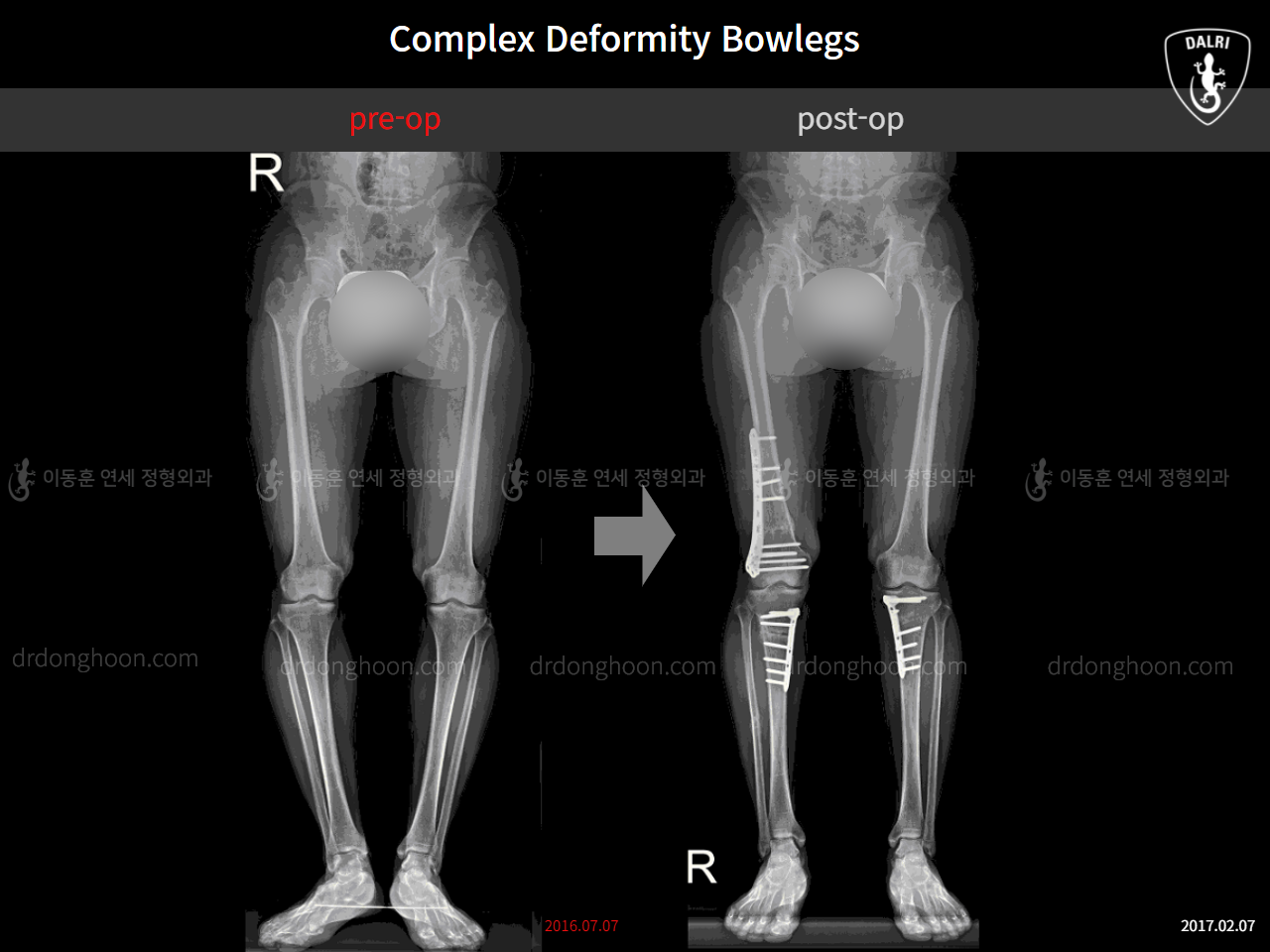 Before and after complex deformity, case 11269840, image 2, Dr. Donghoon institute (DALRI)