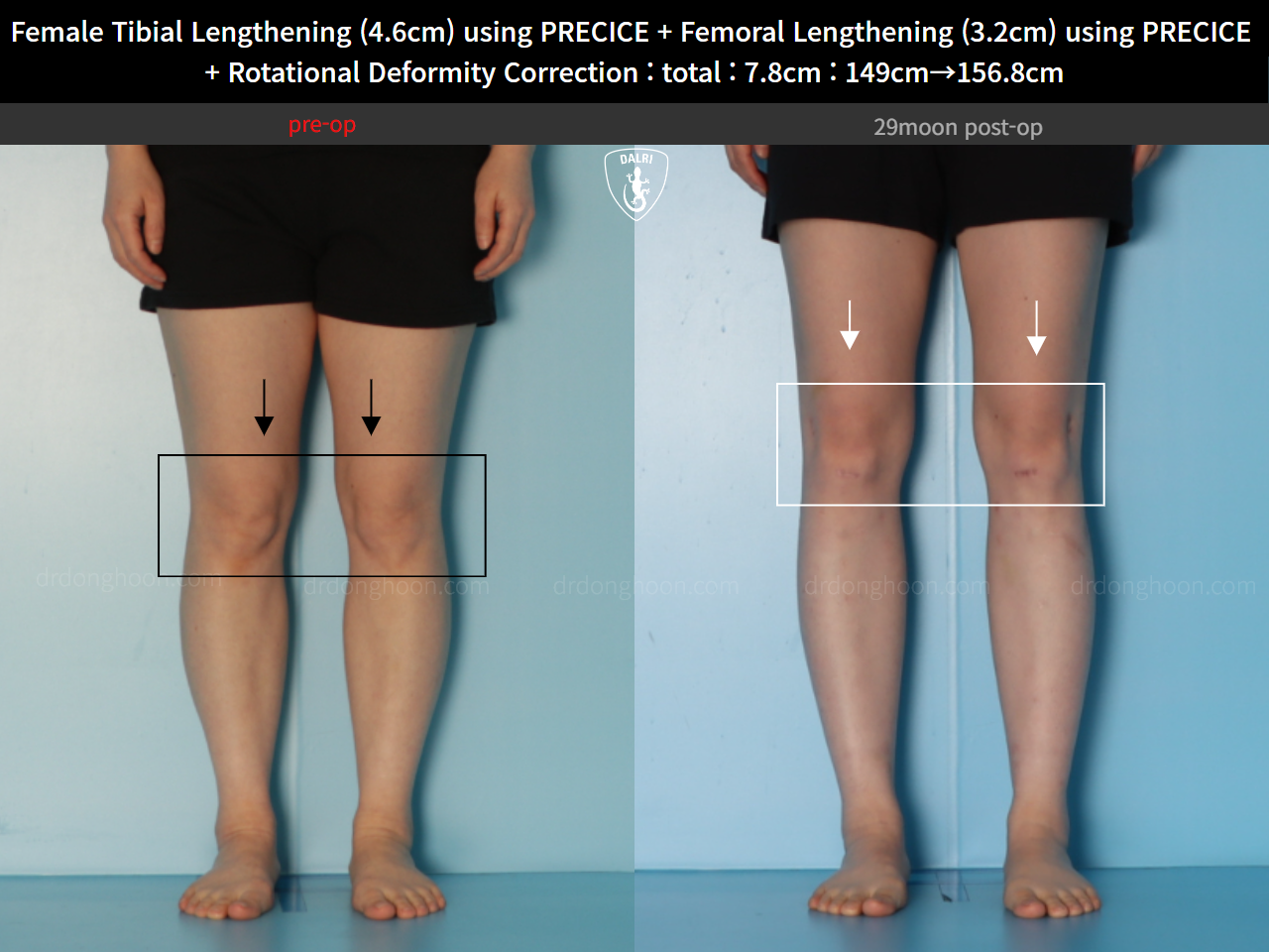 Before and after cll precice, case 123686647, image 8, Dr. Donghoon institute (DALRI)