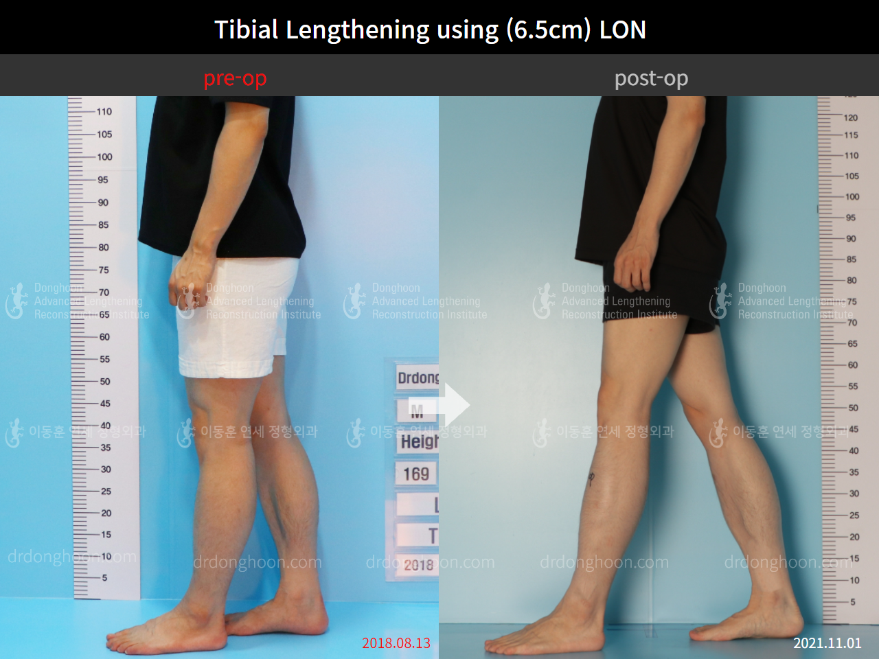 Before and after cll lon, case 8777040, image 8, Dr. Donghoon institute (DALRI)