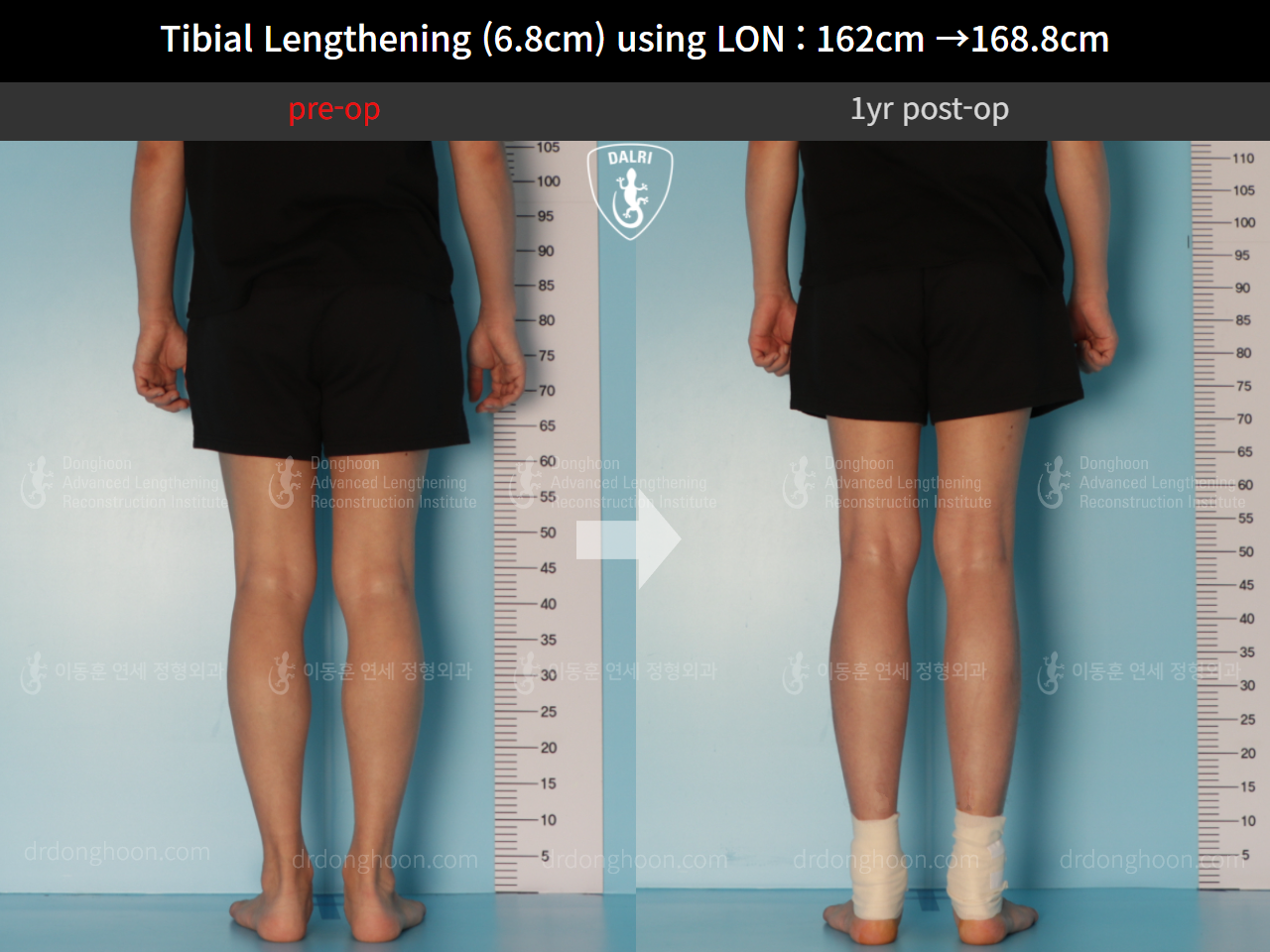 Before and after cll lon, case 10294551, image 6, Dr. Donghoon institute (DALRI)