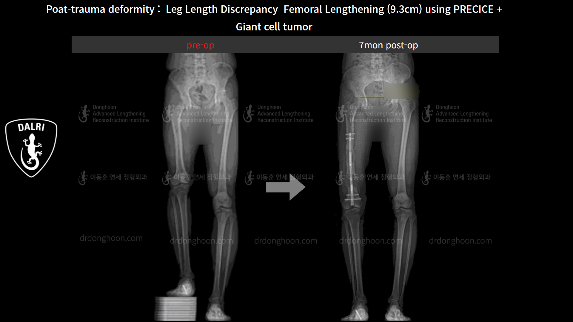Before and after post-trauma deformity, case 8606746, image 5, Dr. Donghoon institute (DALRI)