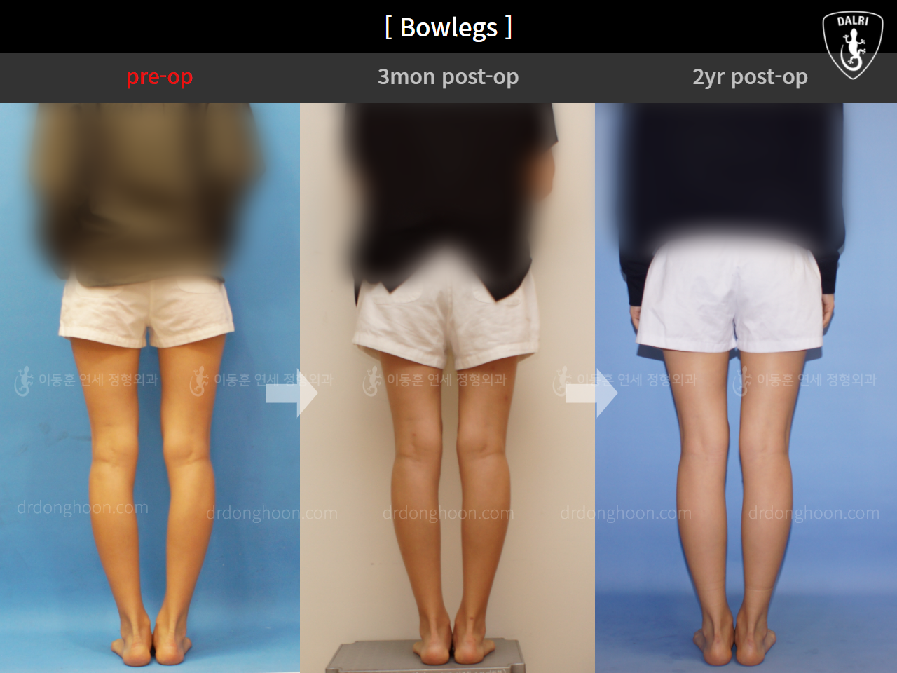 Before and after adult bowlegs, case 4311371, image 2, Dr. Donghoon institute (DALRI)