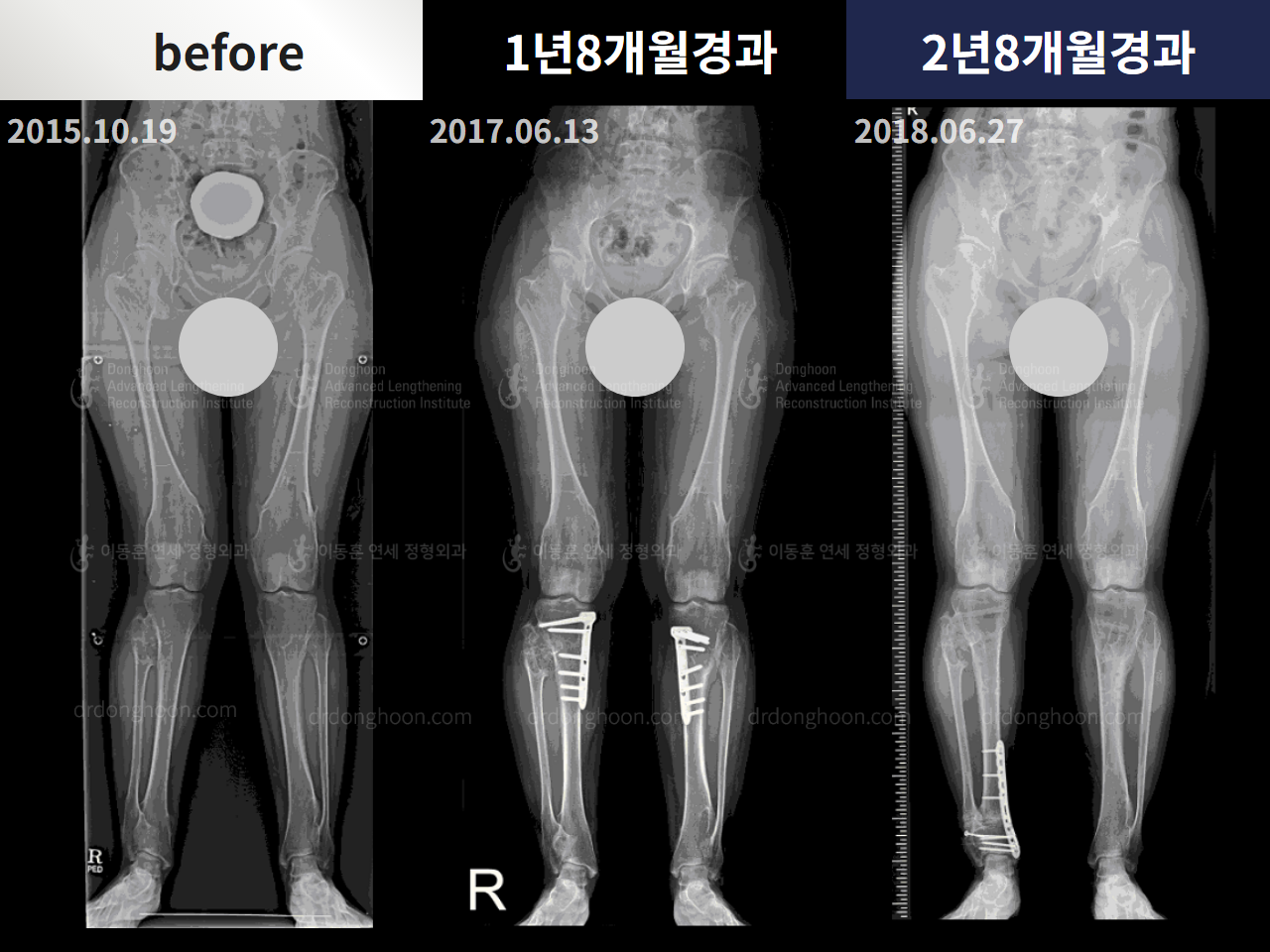 Before and after congenital condition, case 4304666, image 3, Dr. Donghoon institute (DALRI)