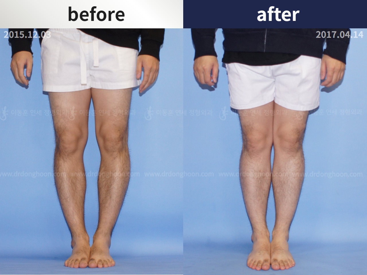 Before and after adult bowlegs, case 4311051, image 1, Dr. Donghoon institute (DALRI)