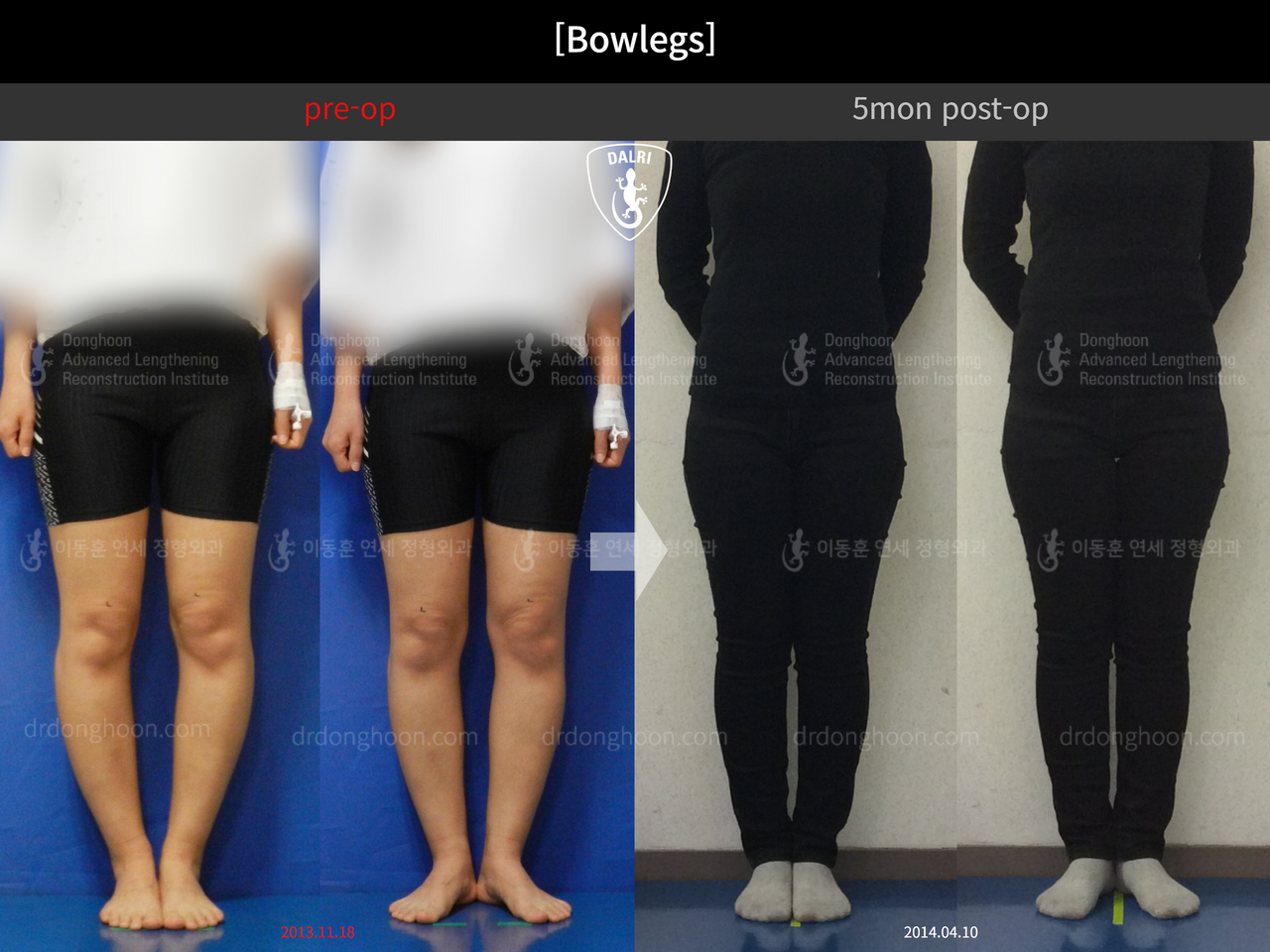 Before and after adult bowlegs, case 12505161, image 5, Dr. Donghoon institute (DALRI)