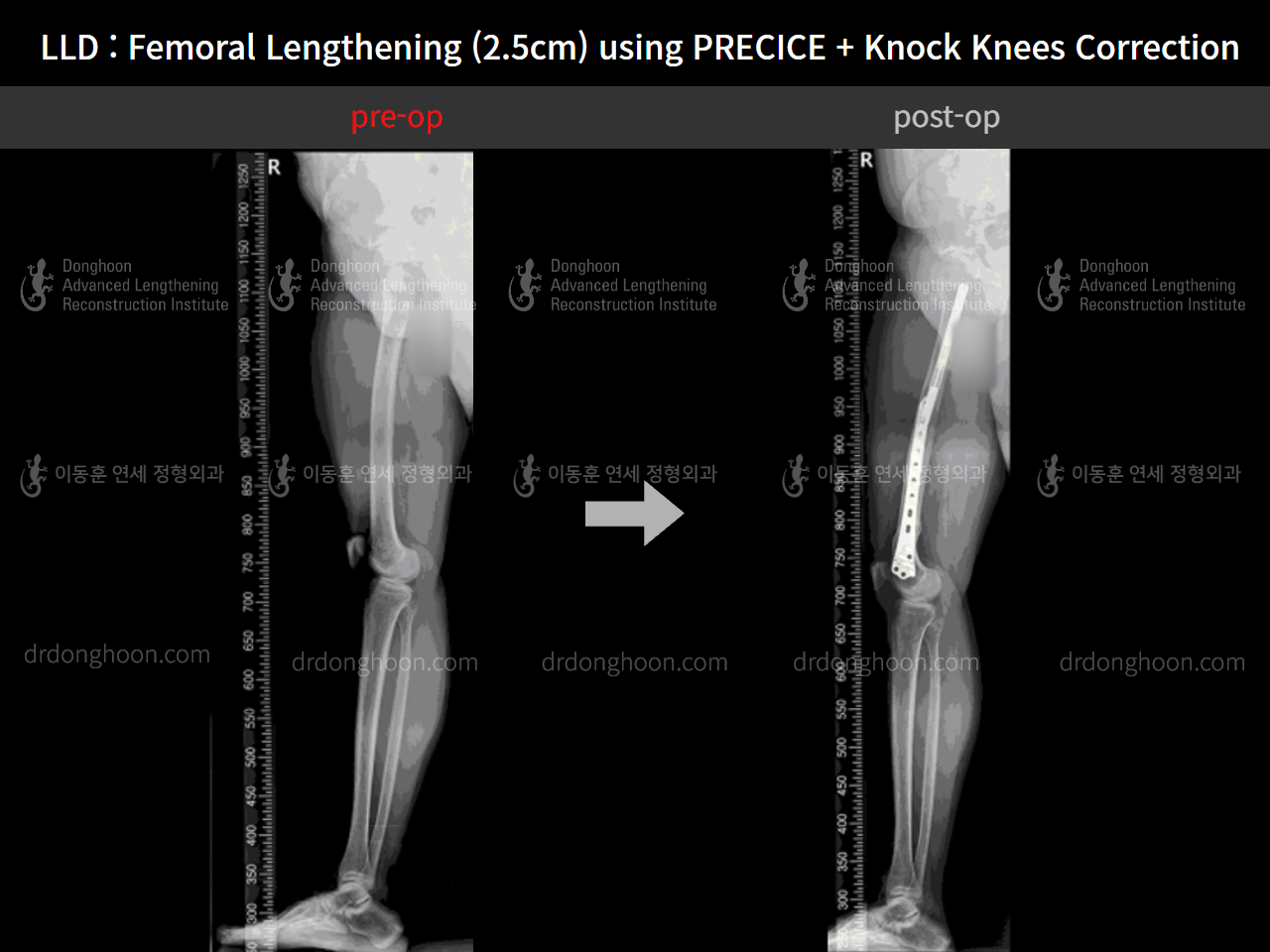 Before and after adult lld, case 9016415, image 5, Dr. Donghoon institute (DALRI)