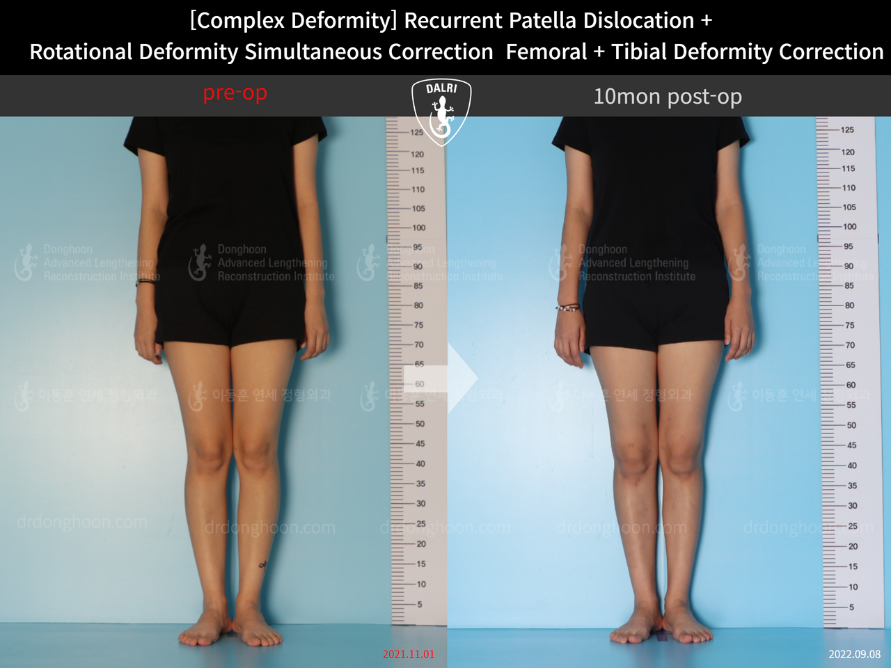 Before and after recurrent patella dislocation, case 12860886, image 2, Dr. Donghoon institute (DALRI)