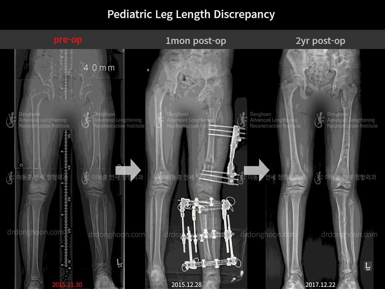Before and after paediatric & adolescent lld, case 4320418, image 3, Dr. Donghoon institute (DALRI)