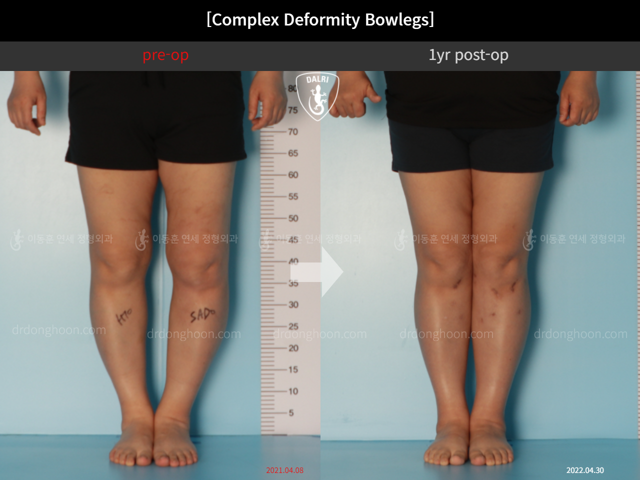 Before and after complex deformity, case 11339608, image 5, Dr. Donghoon institute (DALRI)