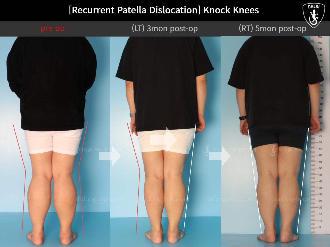 Before and after recurrent patella dislocation, case 10710327, image 2, Dr. Donghoon institute (DALRI)
