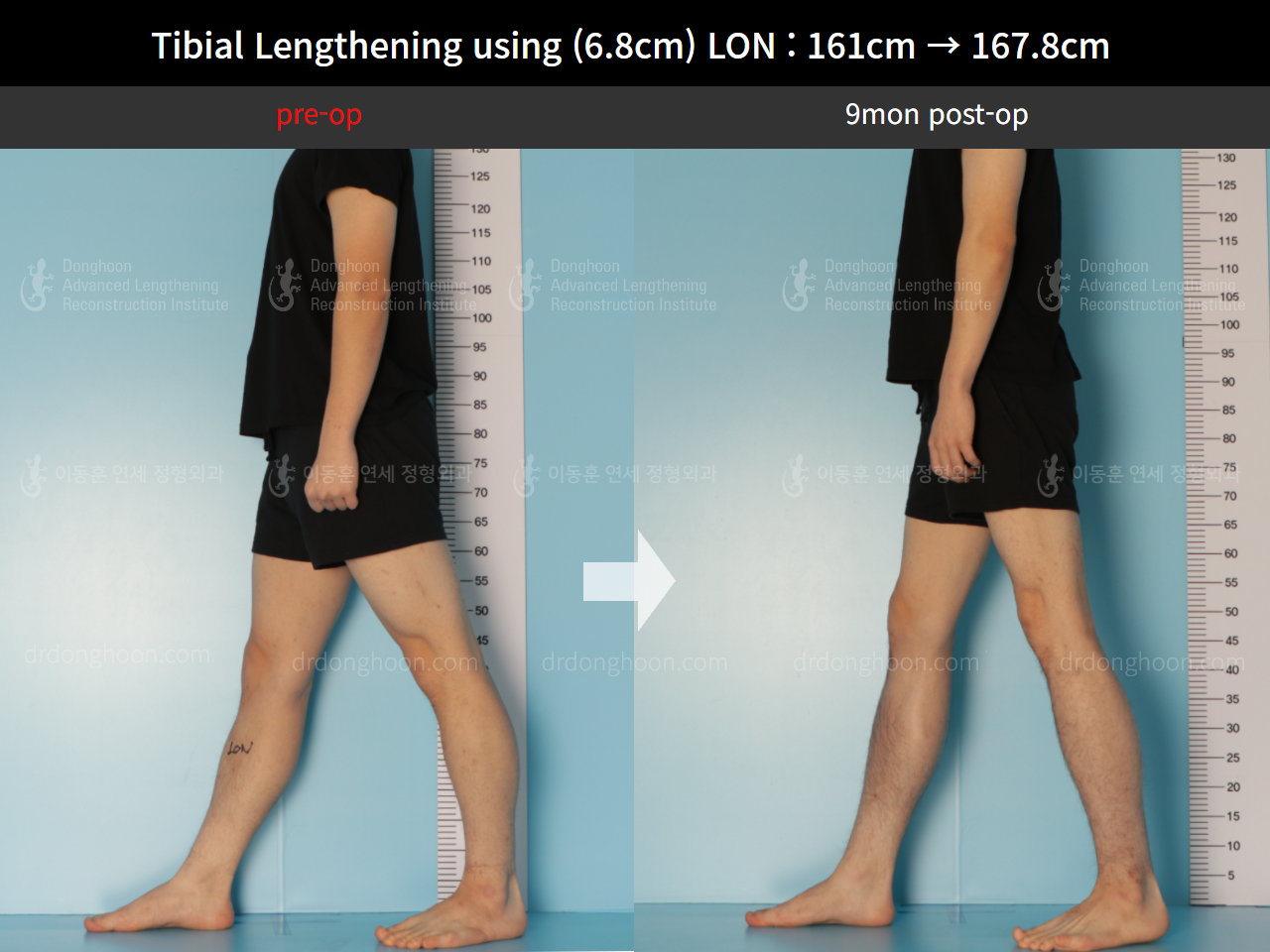 Before and after cll lon, case 8663720, image 3, Dr. Donghoon institute (DALRI)