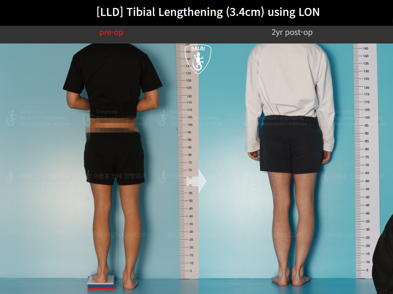 Before and after adult lld, case 17538143, image 2, Dr. Donghoon institute (DALRI)