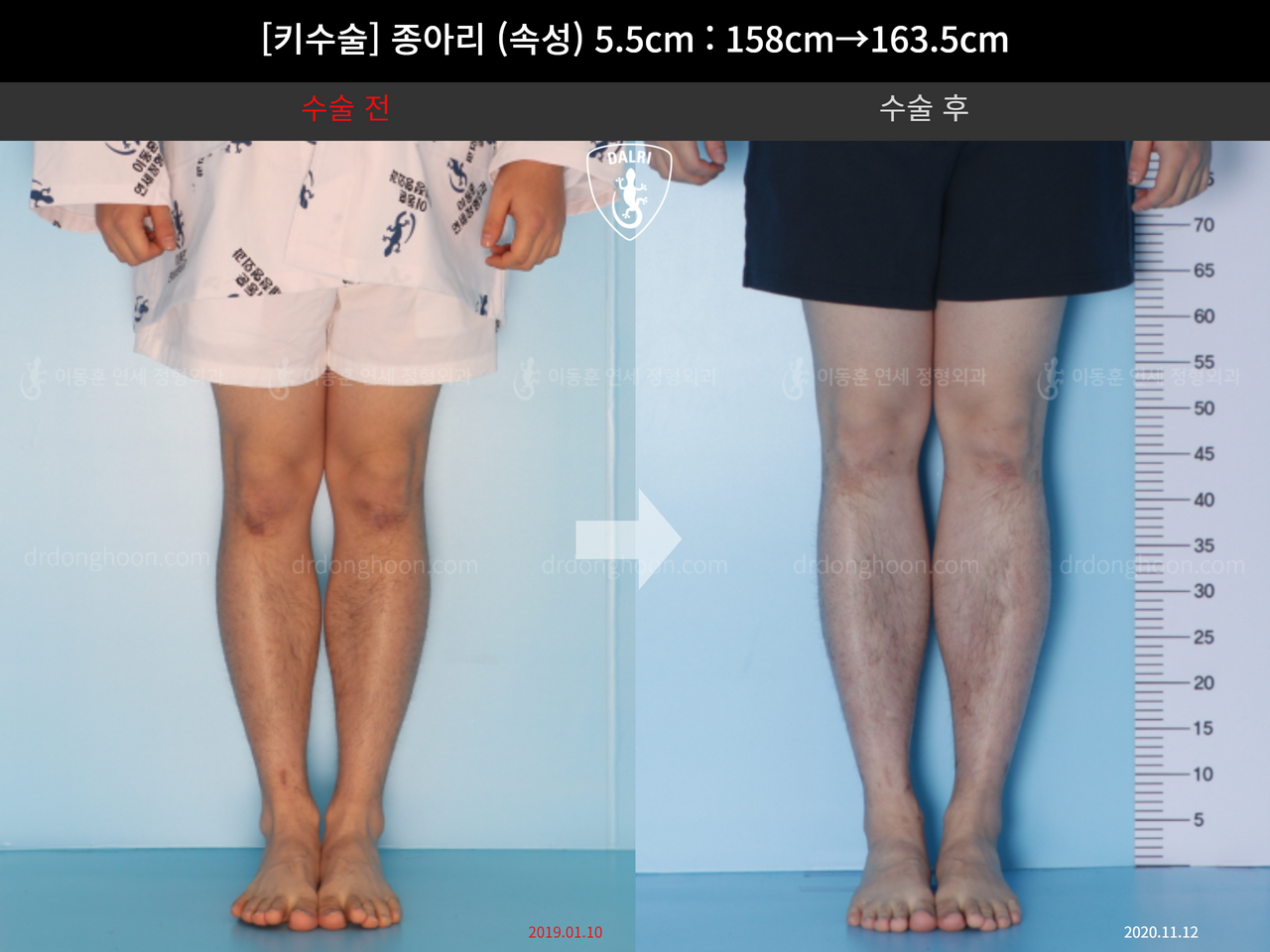 Before and after cll lon, case 4577764, image 5, Dr. Donghoon institute (DALRI)