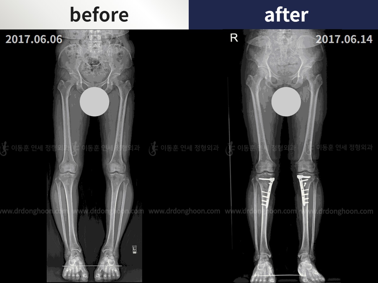 Before and after osteotomy for knee osteoarthritis, case 4306412, image 3, Dr. Donghoon institute (DALRI)