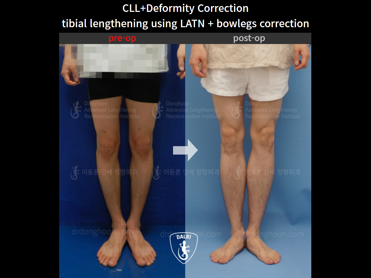 Before and after cll + deformity correction, case 4567585, image 5, Dr. Donghoon institute (DALRI)