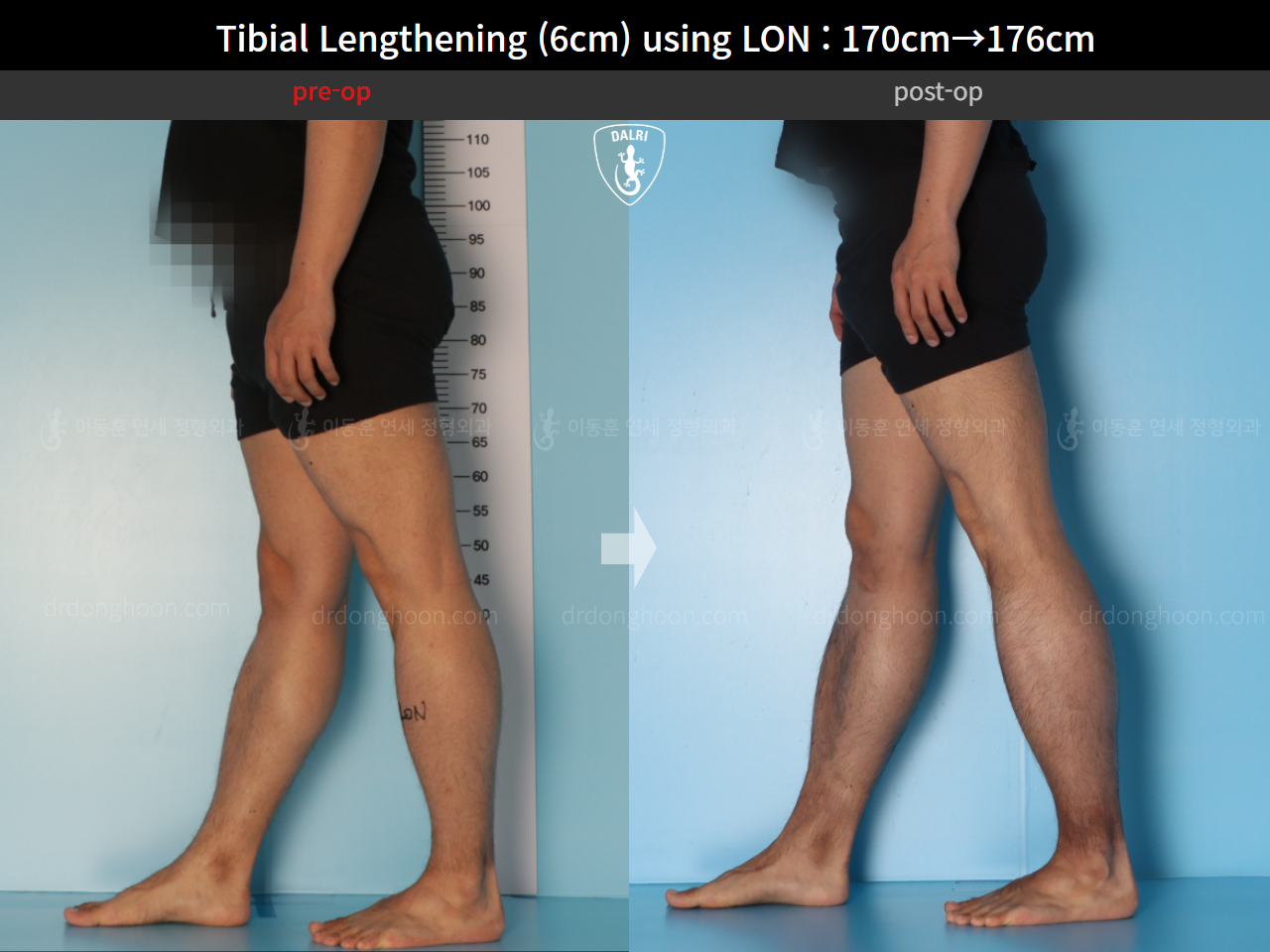 Before and after cll lon, case 15623962, image 9, Dr. Donghoon institute (DALRI)