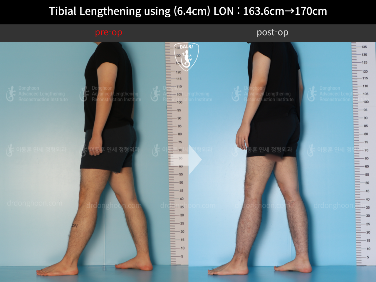 Before and after cll lon, case 12779092, image 4, Dr. Donghoon institute (DALRI)
