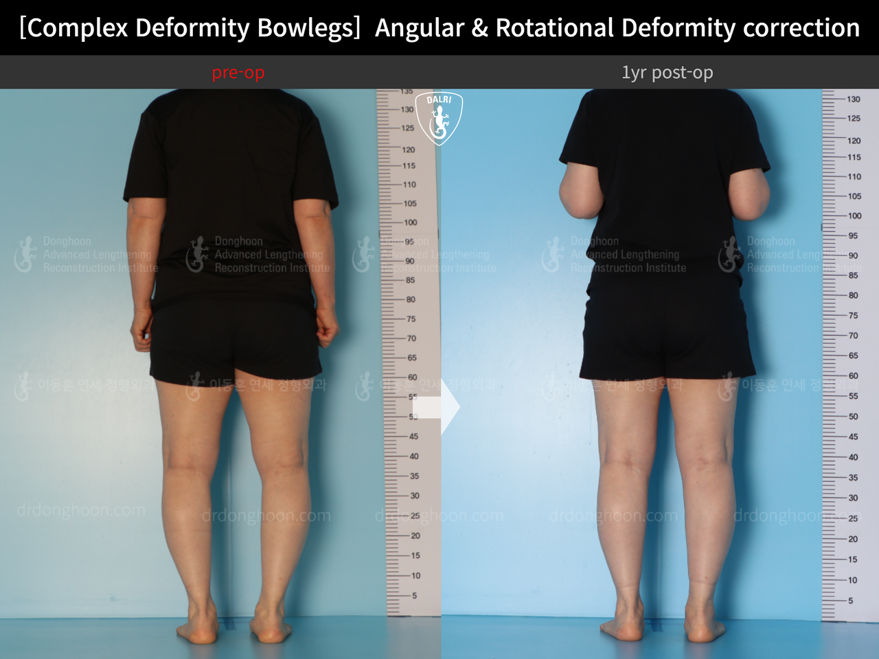 Before and after adult bowlegs, case 14378683, image 4, Dr. Donghoon institute (DALRI)