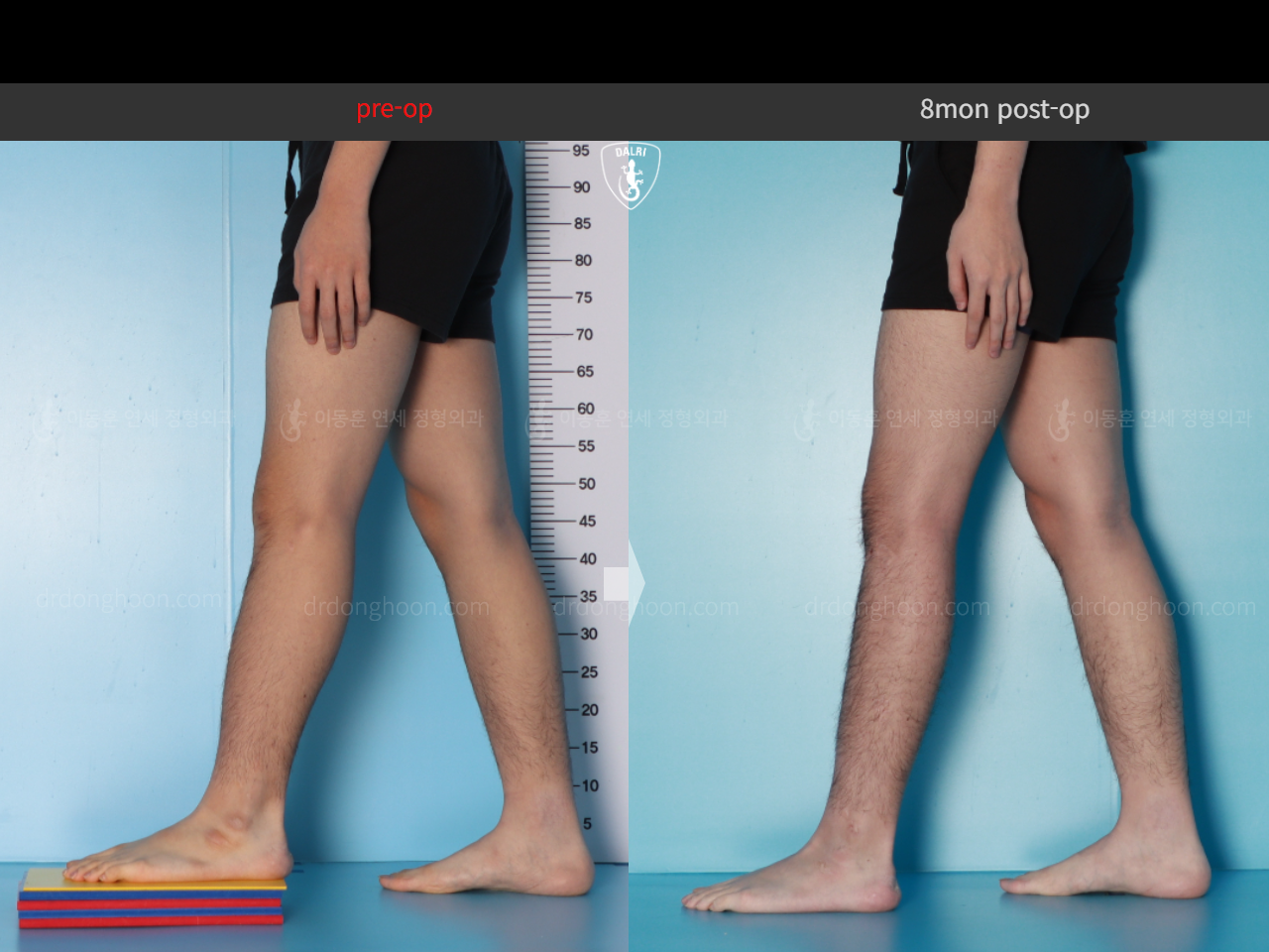 Before and after adult lld, case 16724300, image 8, Dr. Donghoon institute (DALRI)