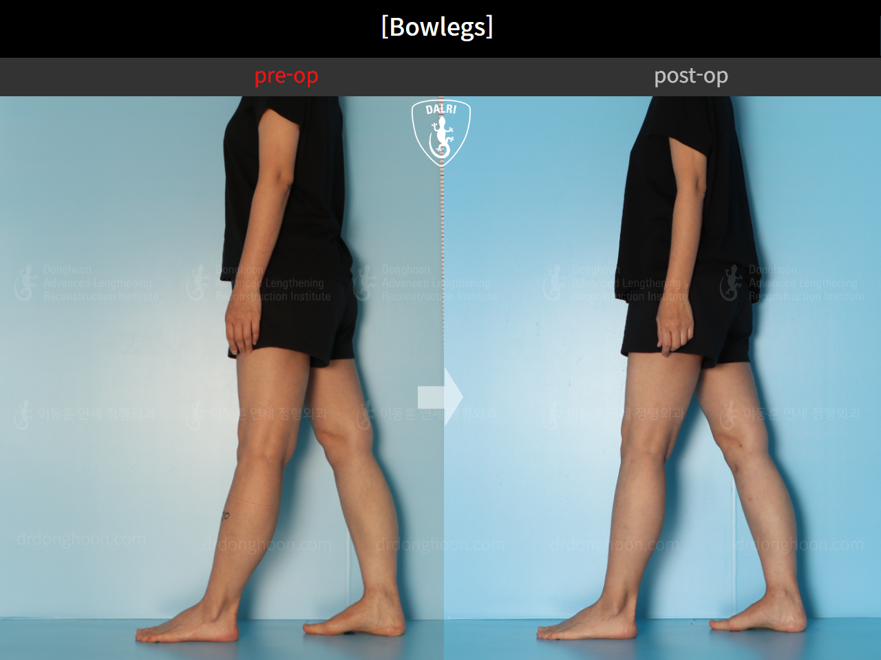Before and after adult bowlegs, case 17463322, image 3, Dr. Donghoon institute (DALRI)