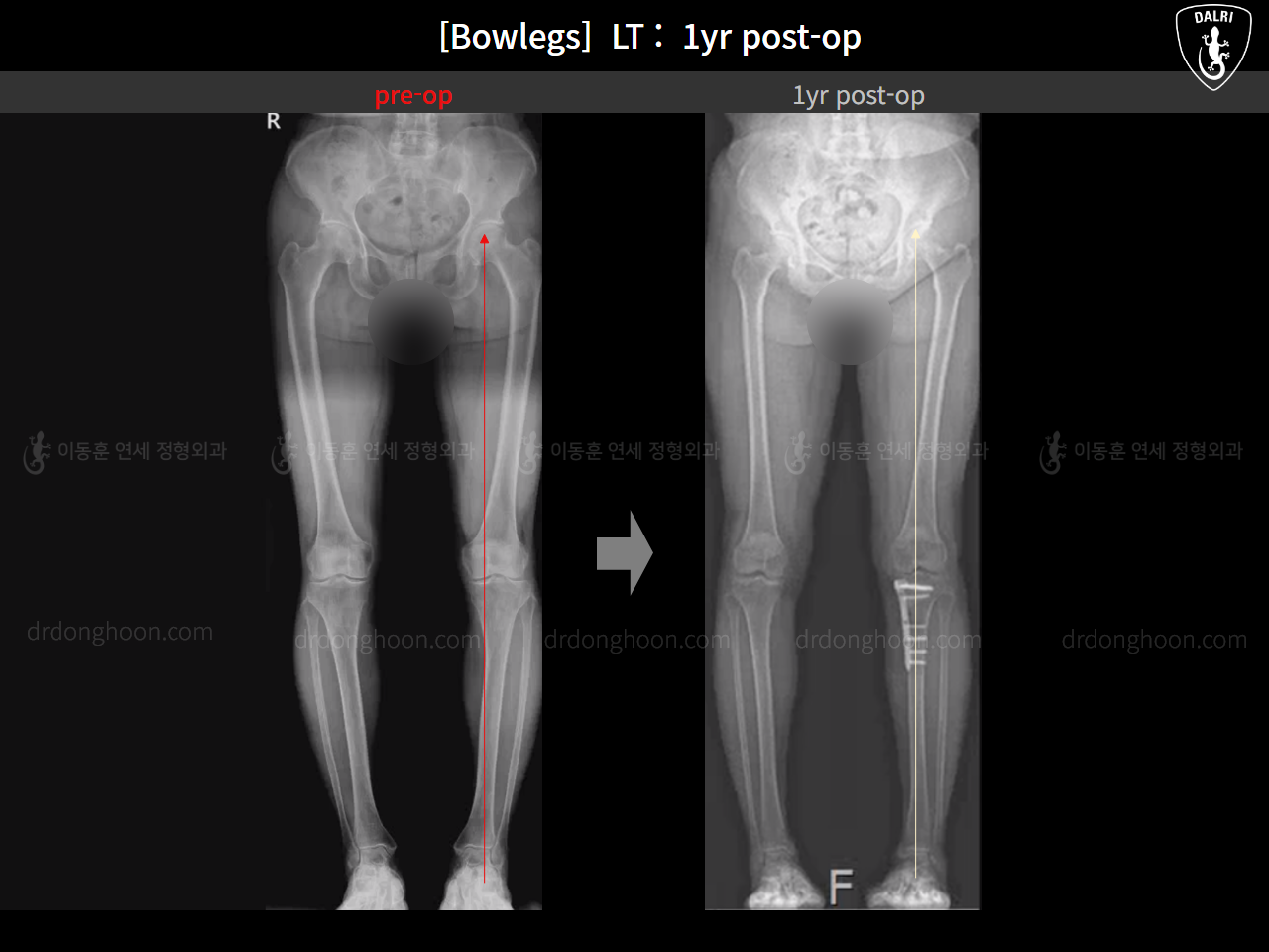 Before and after adult bowlegs, case 15172734, image 13, Dr. Donghoon institute (DALRI)