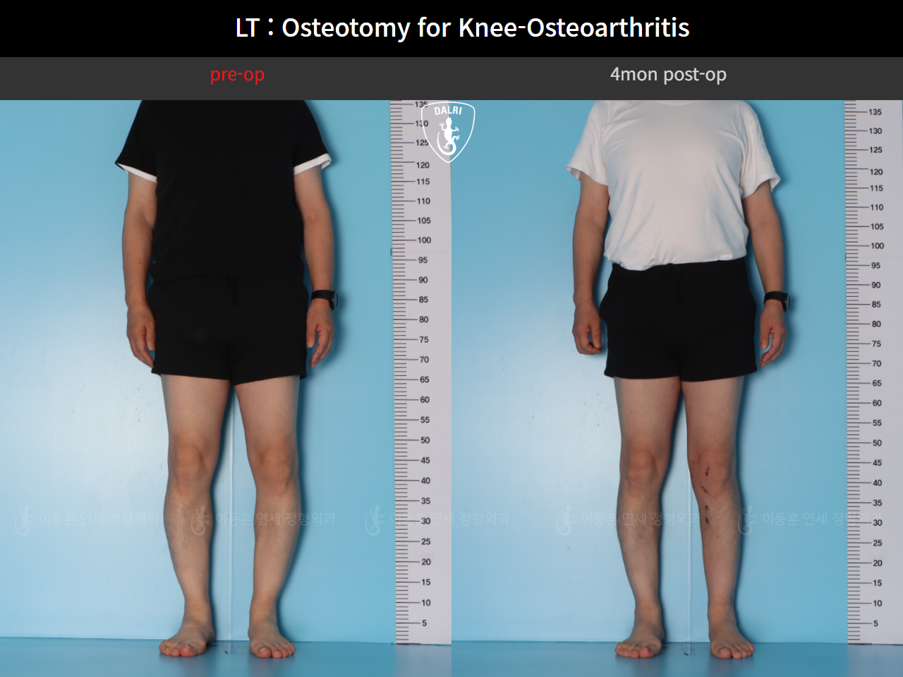 Before and after osteotomy for knee osteoarthritis, case 128374850, image 3, Dr. Donghoon institute (DALRI)